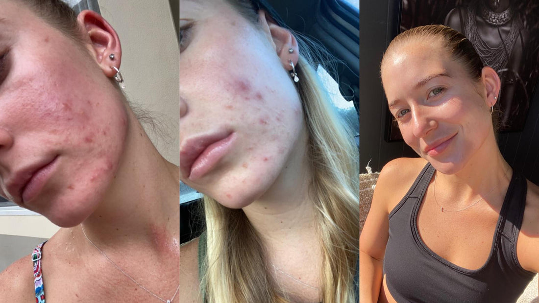 Let's Talk ROACCUTANE